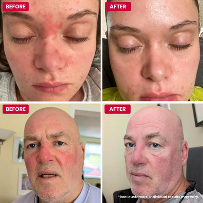 Grahams Natural Rosacea Treatment for Face Redness – Clinically Proven Anti Redness Moisturizer, Soothes & Reduces Flare Ups, Hypoallergenic & Steroid-Free (2.64 oz) Avelisse