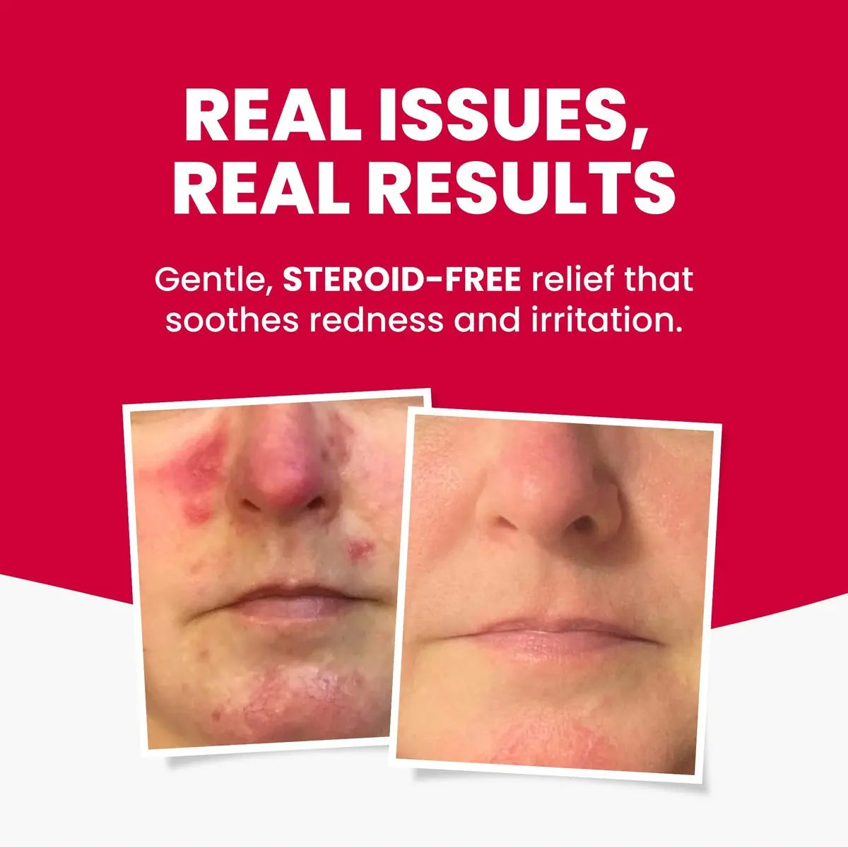 Grahams Natural Rosacea Treatment for Face Redness – Clinically Proven Anti Redness Moisturizer, Soothes & Reduces Flare Ups, Hypoallergenic & Steroid-Free (2.64 oz) Avelisse