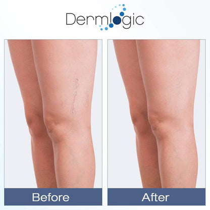 Dermlogic Vitamin K Cream – Moisturizing Bruise Healing Formula with Arnica, Dark Spot Corrector for Bruising, Spider Veins & Broken Capillaries, Reduces Under Eye Dark Circles, Fine Lines, Puffiness & Wrinkles Avelisse