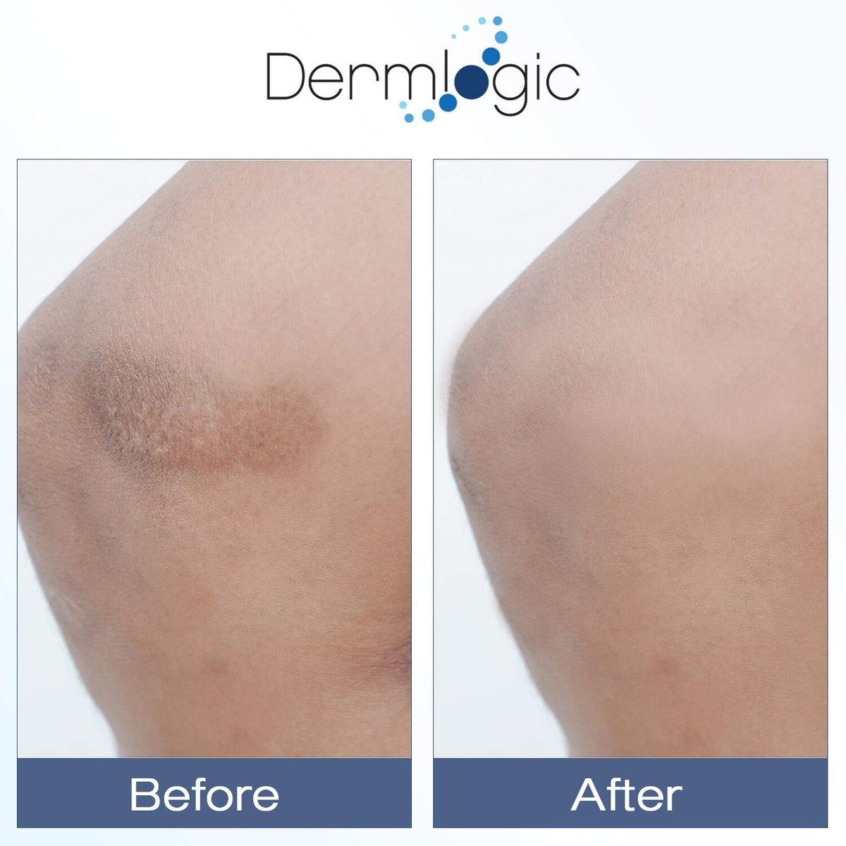 Dermlogic Vitamin K Cream – Moisturizing Bruise Healing Formula with Arnica, Dark Spot Corrector for Bruising, Spider Veins & Broken Capillaries, Reduces Under Eye Dark Circles, Fine Lines, Puffiness & Wrinkles Avelisse