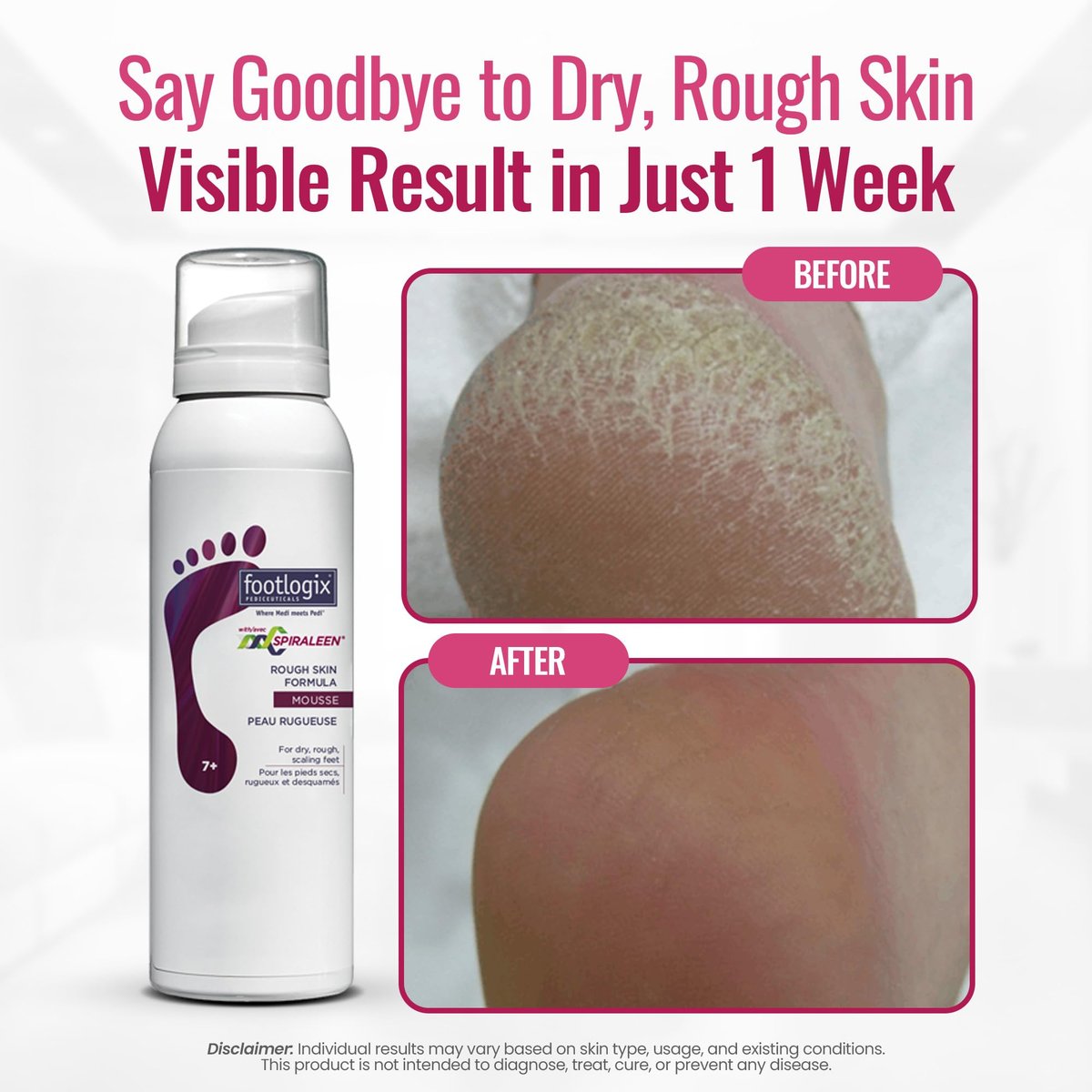 Footlogix Rough Skin Formula with Spiraleen – Mousse for Dry Cracked Heels & Feet | 4.23 oz Avelisse