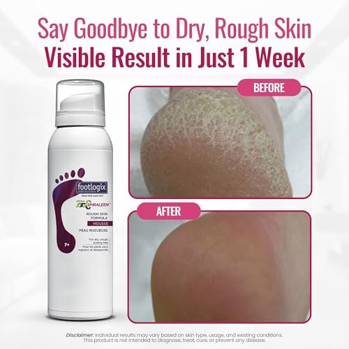 Footlogix Rough Skin Formula with Spiraleen – Mousse for Dry Cracked Heels & Feet | 4.23 oz Avelisse