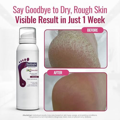 Footlogix Rough Skin Formula with Spiraleen – Mousse for Dry Cracked Heels & Feet | 4.23 oz Avelisse