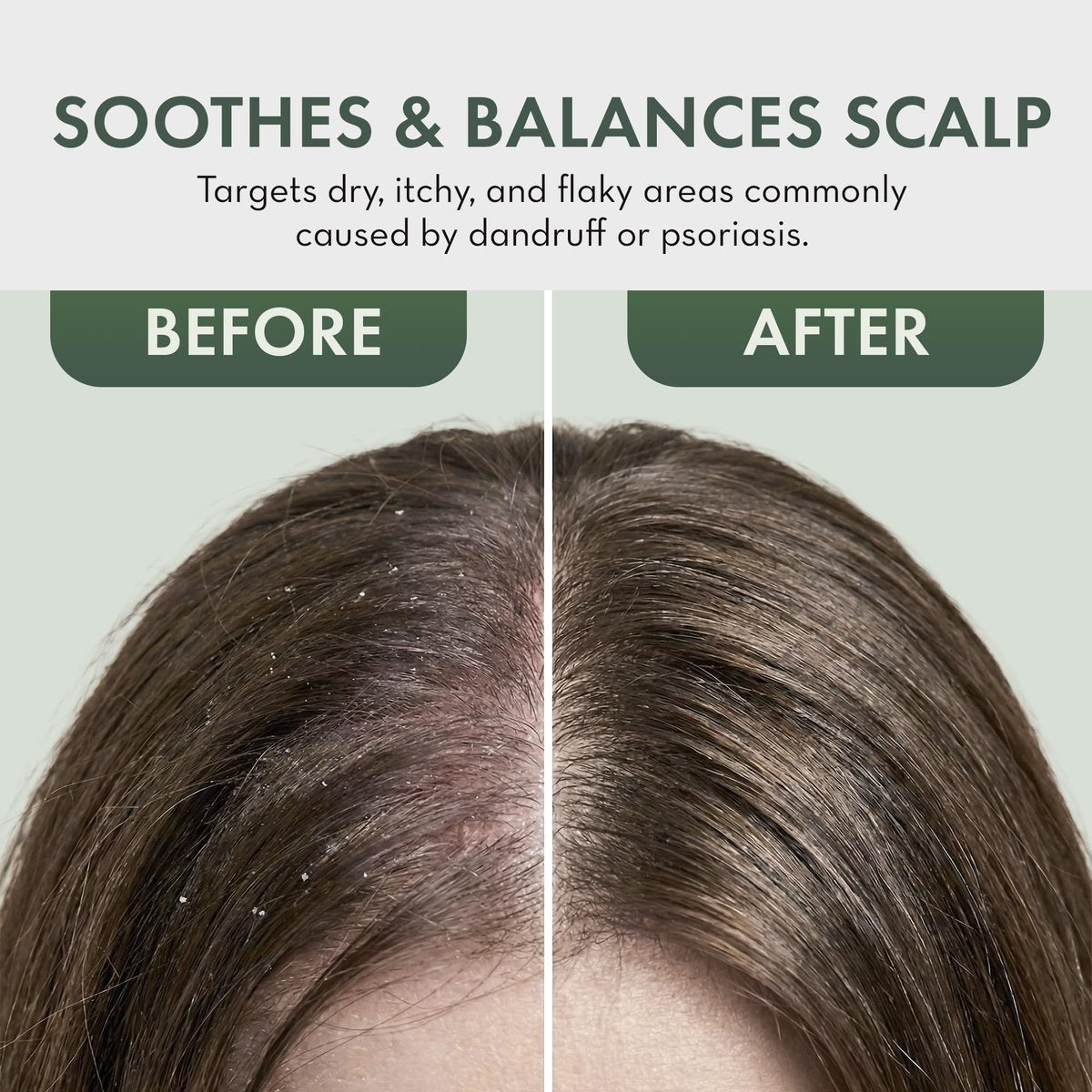 Leave In Conditioner Spray - Tea Tree Scalp Treatment - Anti-Dandruff & Itchy Scalp Relief, Hydrating & Medicated Formula for Psoriasis Care - Detangles & Nourishes Hair (8 Fl Oz) - görsel 9