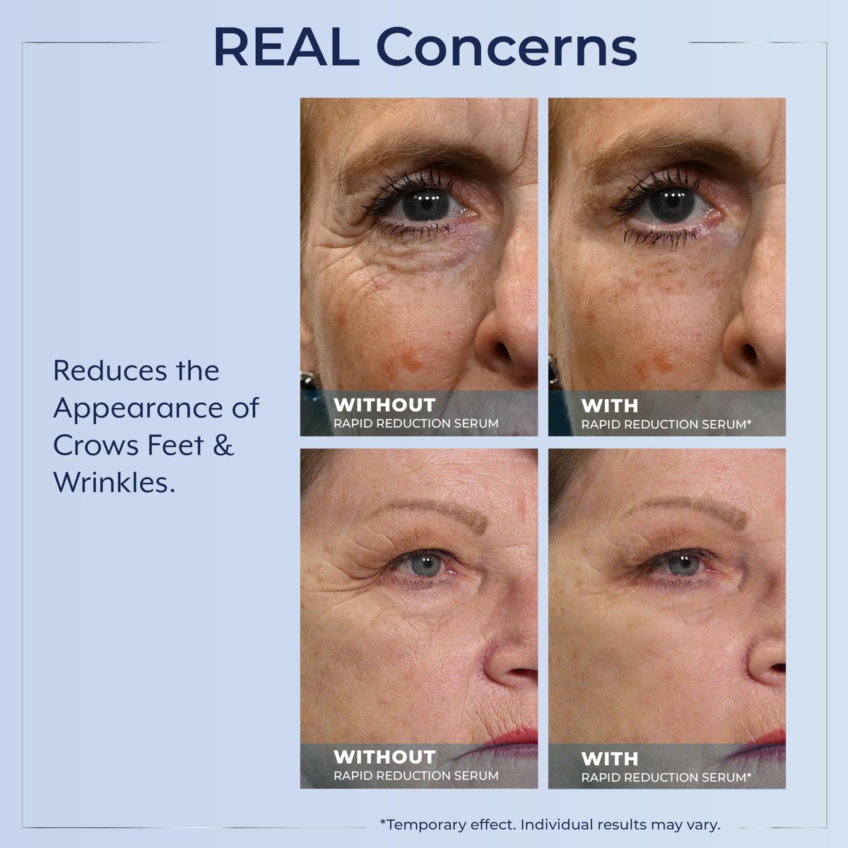 Plexaderm Rapid Reduction Eye Serum - Instantly Reduce Under-Eye Bags, Wrinkles & Dark Circles Avelisse