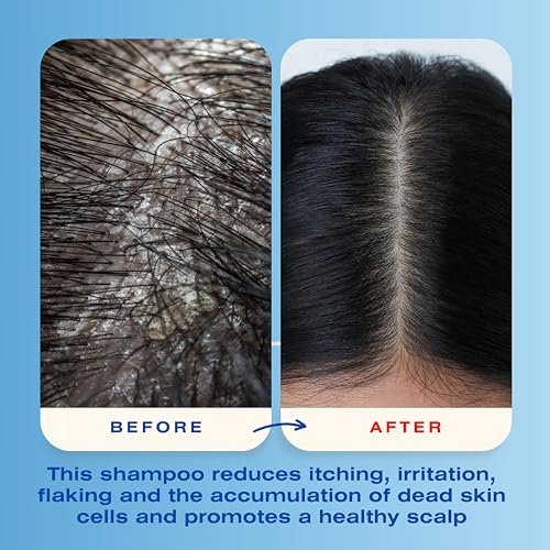 Mediceuticals X-Folate Anti-Dandruff Shampoo – Persistent Dandruff Control for Scaly, Flaky Scalp – Reduces Itching – 8.45 oz Avelisse