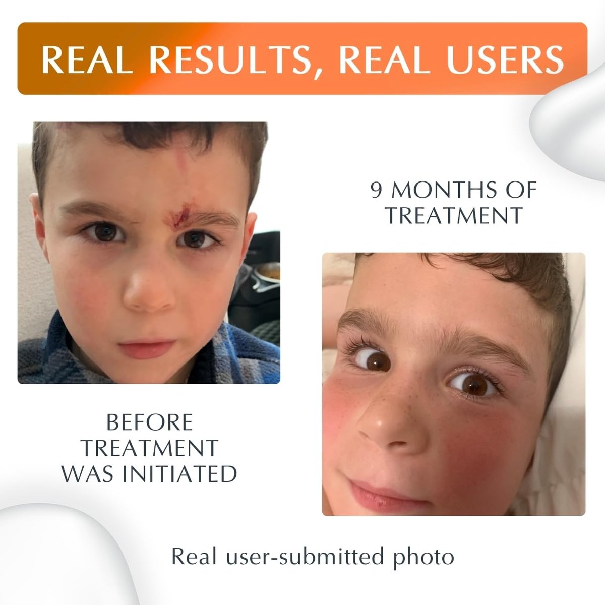 MyNewGel Plus UV Advanced Silicone Scar Gel with SPF30 Mineral Sunscreen - Old & New Scars, 15g (0.5 oz) Avelisse