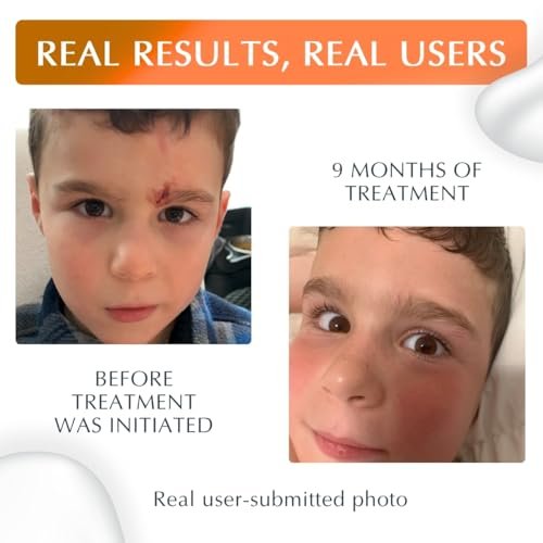 MyNewGel Plus UV Advanced Silicone Scar Gel with SPF30 Mineral Sunscreen - Old & New Scars, 15g (0.5 oz) Avelisse