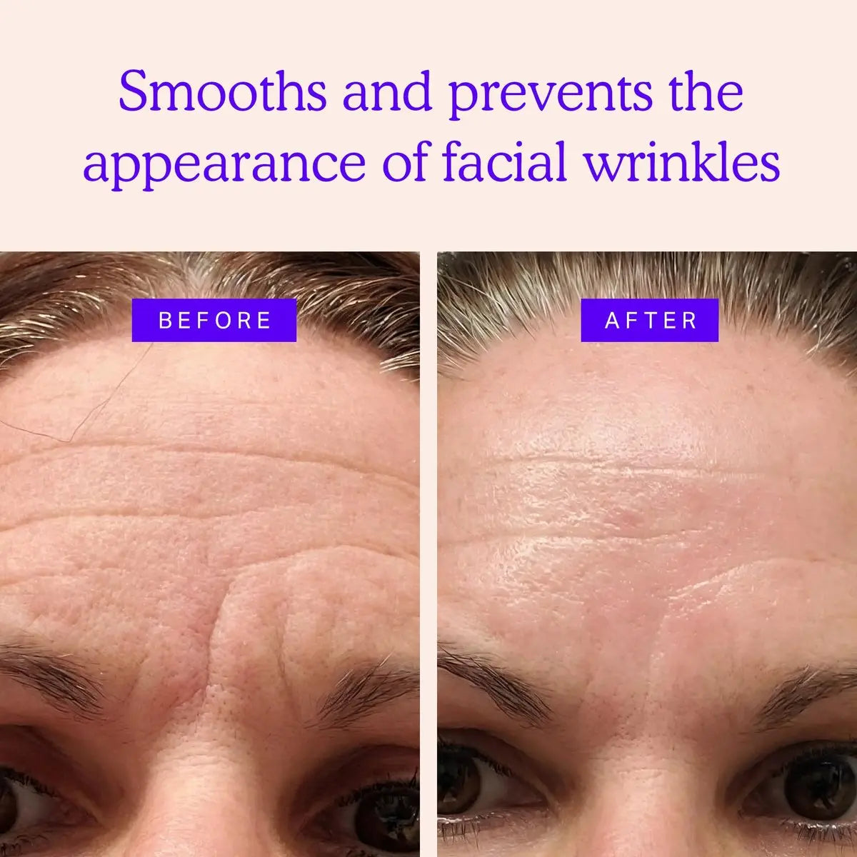 BLUMBODY Face Forehead Wrinkle Patches – 160 Triangle Anti-Wrinkle Facial Patches for Eyes, Mouth, Forehead – Non-Silicone Face Tape for Elevens, Crow's Feet and Fine Lines Avelisse