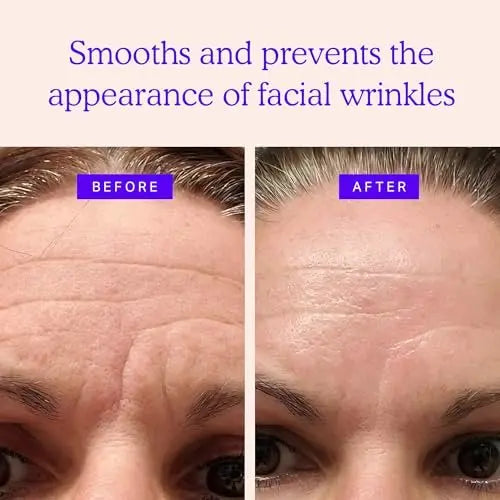 BLUMBODY Face Forehead Wrinkle Patches – 160 Triangle Anti-Wrinkle Facial Patches for Eyes, Mouth, Forehead – Non-Silicone Face Tape for Elevens, Crow's Feet and Fine Lines Avelisse