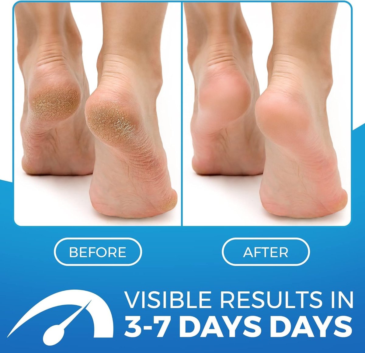 Imperial Feet 2 in 1 Foot Cream for Dry Cracked Heels - XL Foot Repair Cream for Dry Feet - Suitable for Diabetics - Professional Grade - görsel 3