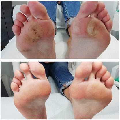 Imperial Feet 2 in 1 Foot Cream for Dry Cracked Heels - XL Foot Repair Cream for Dry Feet - Suitable for Diabetics - Professional Grade