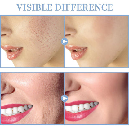 TUMAKOU High Frequency Facial Machine - Portable Handheld Skin Wand with 4 Tubes for Acne, Wrinkle & Skin Rejuvenation Avelisse