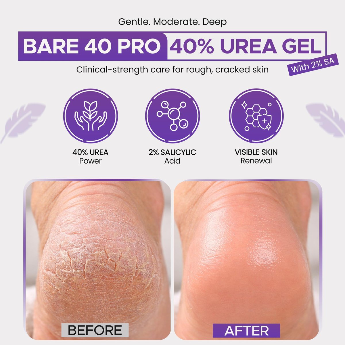 BARE 40 PRO 40% Urea Gel with 2% Salicylic Acid, Hyaluronic Acid, Tea Tree Oil & Aloe Vera – Exfoliating & Hydrating Foot and Body Gel for Dry, Rough Skin, 4oz Jar, Made in USA Avelisse