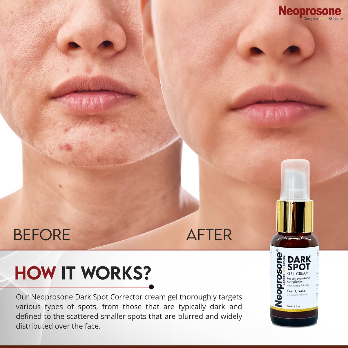 Neoprosone Dark Spot Remover for Face & Body - Brightening Cream for Blemishes, Sun Spots, Brown Spots - 1 Fl Oz Avelisse