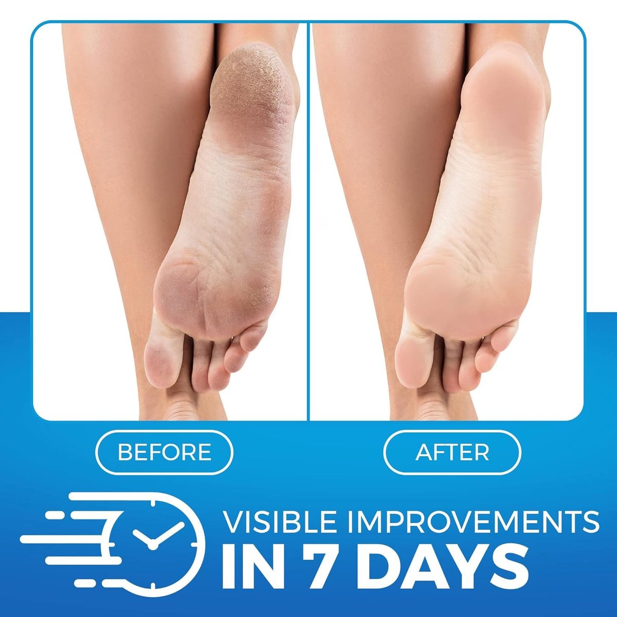 Imperial Feet Urea Foot Balm - Natural Urea Cream for Cracked Heels, Calluses, and Dry Feet - 5.07 oz Avelisse