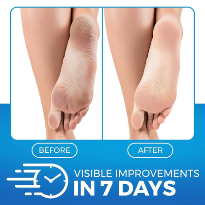 Imperial Feet Urea Foot Balm - Natural Urea Cream for Cracked Heels, Calluses, and Dry Feet - 5.07 oz Avelisse