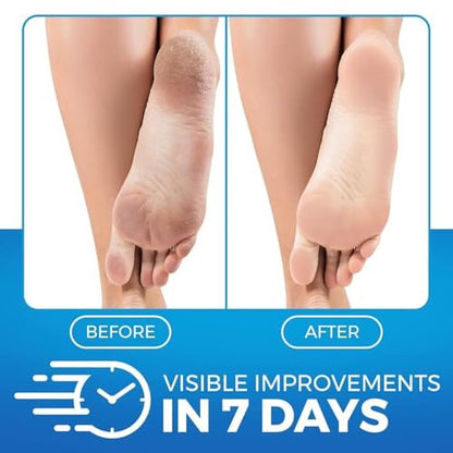 Imperial Feet Urea Foot Balm - Natural Urea Cream for Cracked Heels, Calluses, and Dry Feet - 5.07 oz Avelisse