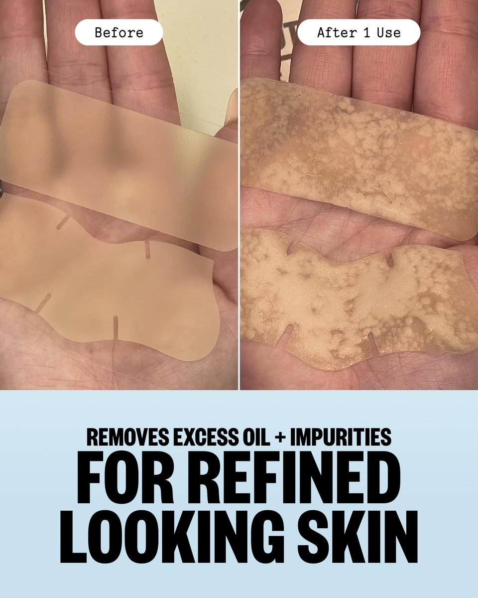 PEACE OUT Pore Strips for Nose and Face – Oil Absorbing Hydrocolloid Blackhead Remover, Pore Minimizing Strips with Retinol, Multi-Use Face Strips for Clogged Pores (8 Count) Avelisse