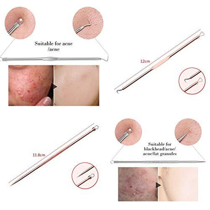 ZTRHYOO Blackhead Remover Tool Kit - Professional Acne Extraction Kit with Stainless Steel Pimple Comedone Extractor, Blemish Popping Tool for Face Nose (Rose, 4 Pieces)