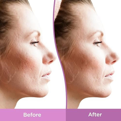 Differin Gel Acne Scar Spot Treatment for Face - Resurfacing Scar Gel, Gentle for Acne Prone Sensitive Skin, 1 Oz