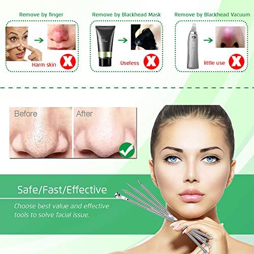 Professional Blackhead Remover Tool Kit - 5-Piece Stainless Steel Comedone Extractor Set for Acne, Pimple, and Blemish Removal - görsel 3