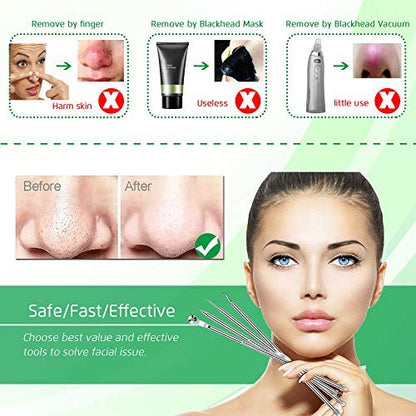 Professional Blackhead Remover Tool Kit - 5-Piece Stainless Steel Comedone Extractor Set for Acne, Pimple, and Blemish Removal