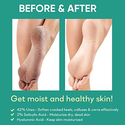 Ellocy 42% Urea Gel with Salicylic & Hyaluronic Acid - Cracked Heel Repair & Callus Remover for Feet, Elbows, Hands - 4 oz Avelisse
