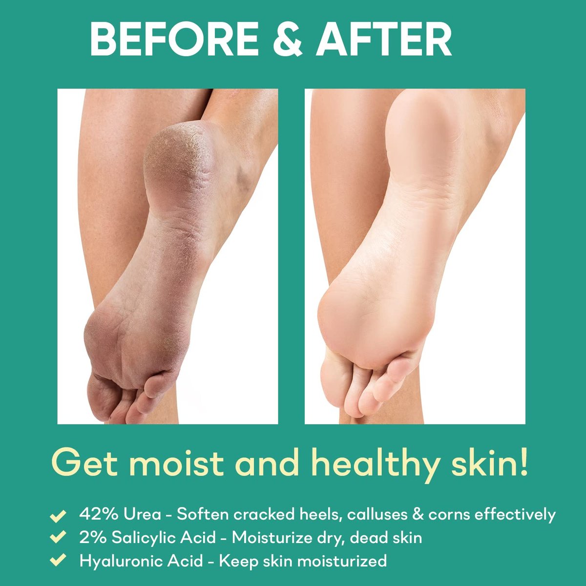 Ellocy 42% Urea Gel with Salicylic & Hyaluronic Acid - Cracked Heel Repair & Callus Remover for Feet, Elbows, Hands - 4 oz Avelisse