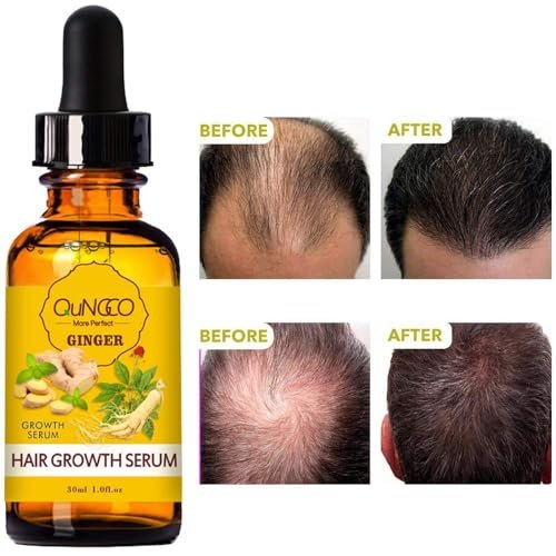 5 Pack Hair Growth Serum – Natural Ginger Essential Oil for Thicker, Stronger Hair | QUNGCO Avelisse