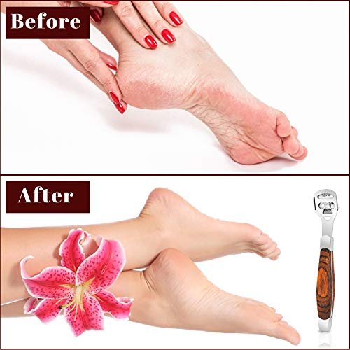 Stainless Steel Callus Shaver for Feet – Professional Foot File with 10 Blades & Dead Skin Storage Cover (7-Piece Kit) - görsel 14