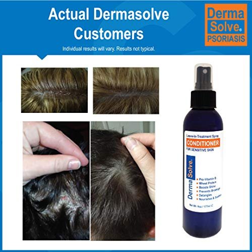 Dermasolve Psoriasis Leave-In Treatment & Styling Spray Conditioner – Soothing Anti-Dandruff, Dry Scalp Repair for Damaged Hair, 6 oz Avelisse