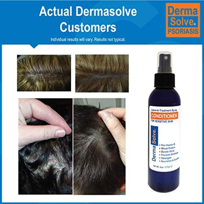 Dermasolve Psoriasis Leave-In Treatment & Styling Spray Conditioner – Soothing Anti-Dandruff, Dry Scalp Repair for Damaged Hair, 6 oz Avelisse