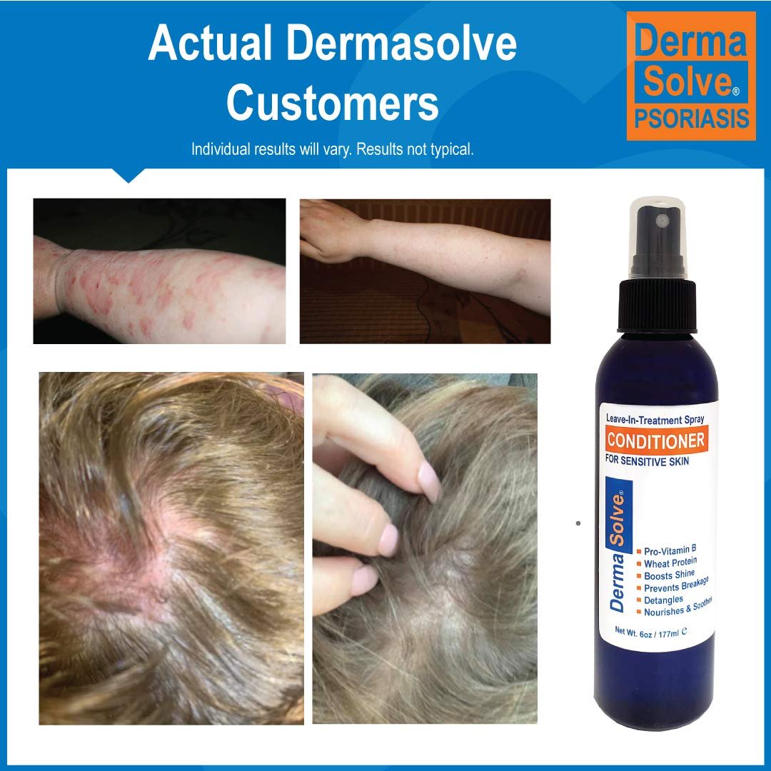 Dermasolve Psoriasis Leave-In Treatment & Styling Spray Conditioner – Soothing Anti-Dandruff, Dry Scalp Repair for Damaged Hair, 6 oz Avelisse