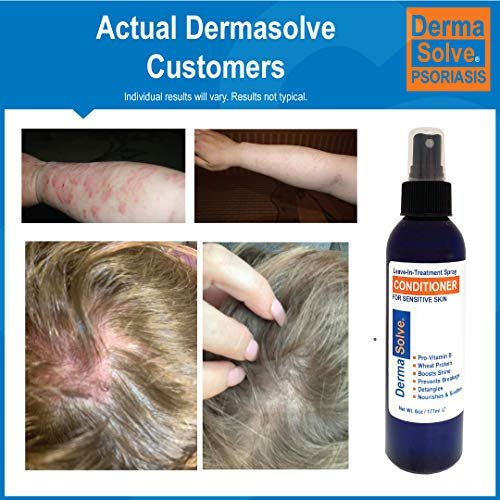 Dermasolve Psoriasis Leave-In Treatment & Styling Spray Conditioner – Soothing Anti-Dandruff, Dry Scalp Repair for Damaged Hair, 6 oz Avelisse