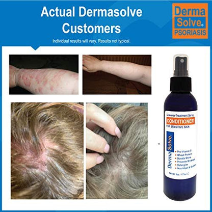 Dermasolve Psoriasis Leave-In Treatment & Styling Spray Conditioner – Soothing Anti-Dandruff, Dry Scalp Repair for Damaged Hair, 6 oz Avelisse