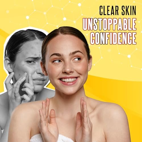 Biosulfur Grisi Acne Treatment Soap - Deep Cleansing, Acne-Fighting Sulfur Soap Bar, Reduces Inflammation, Prevents Breakouts & Blackheads, 4.4 oz, 3-Pack Avelisse