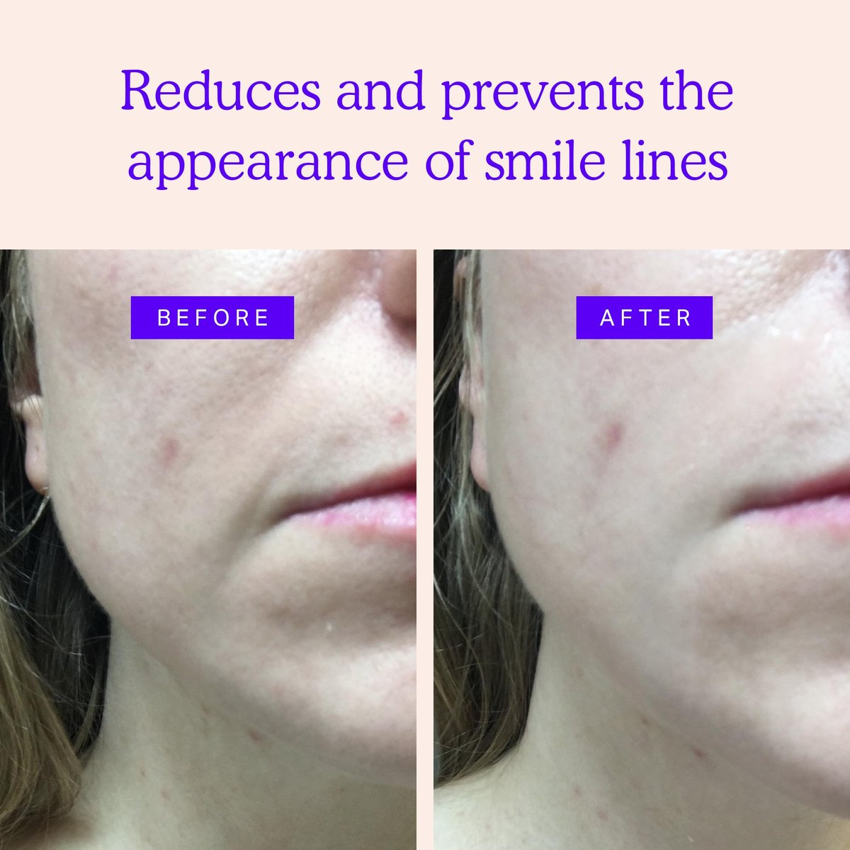 BLUMBODY Smile Line Patches – Face Wrinkle Patches for Fine Lines Around Mouth & Between Eyes – Non-Silicone Anti-Wrinkle Facial Tape – Comfortable Overnight Use (90-Day Supply) Avelisse