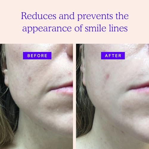 BLUMBODY Smile Line Patches – Face Wrinkle Patches for Fine Lines Around Mouth & Between Eyes – Non-Silicone Anti-Wrinkle Facial Tape – Comfortable Overnight Use (90-Day Supply) Avelisse