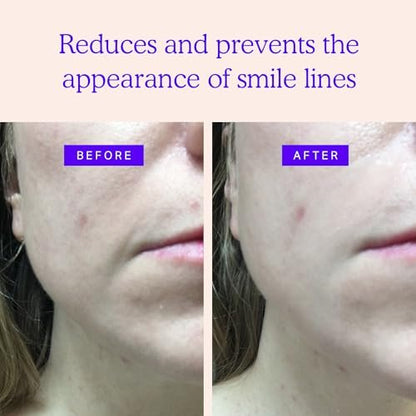 BLUMBODY Smile Line Patches – Face Wrinkle Patches for Fine Lines Around Mouth & Between Eyes – Non-Silicone Anti-Wrinkle Facial Tape – Comfortable Overnight Use (90-Day Supply) Avelisse