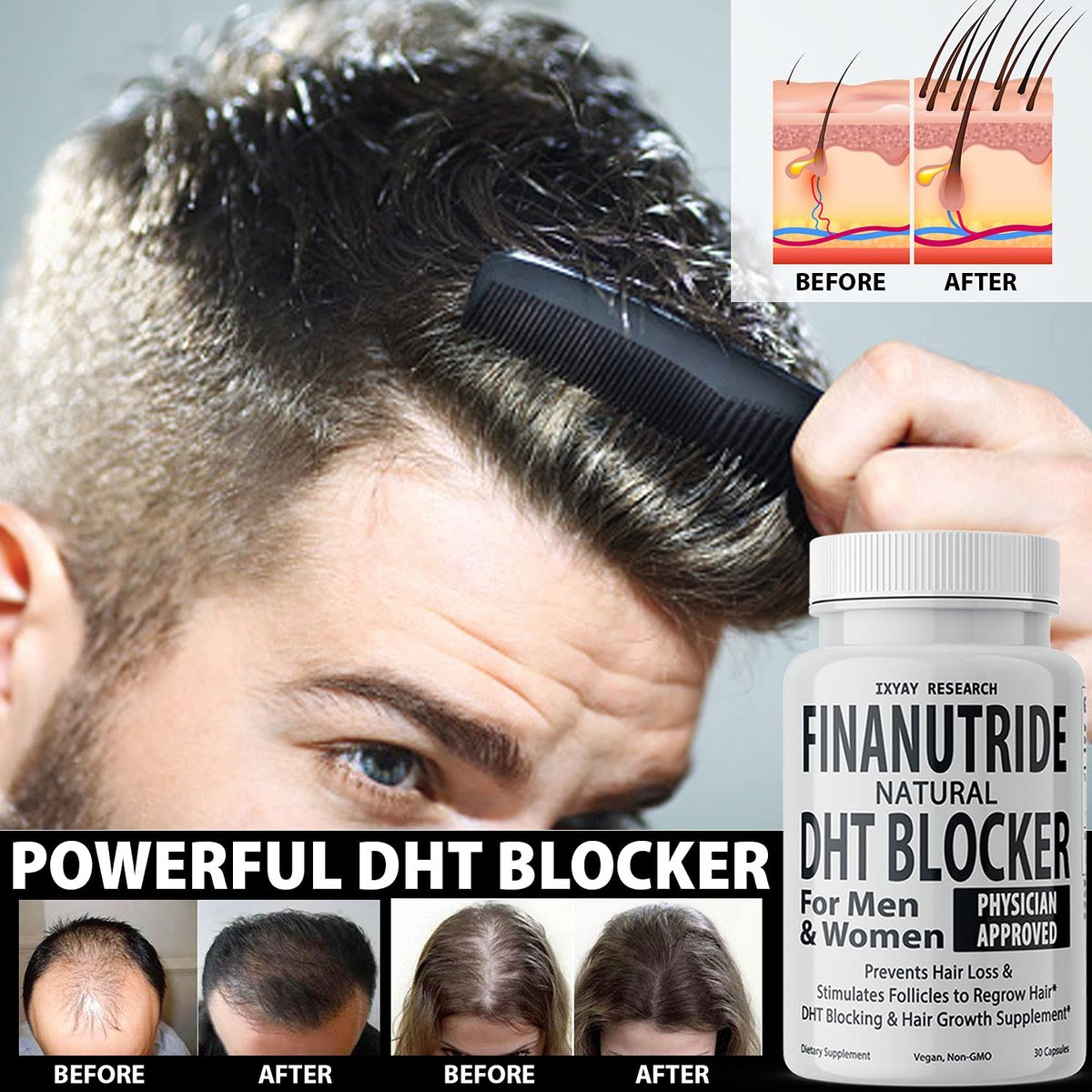 Finanutride Natural DHT Blocker & Hair Growth Capsules – Prevent Hair Loss, Stimulate Follicles, Proprietary Regrowth Treatment Avelisse