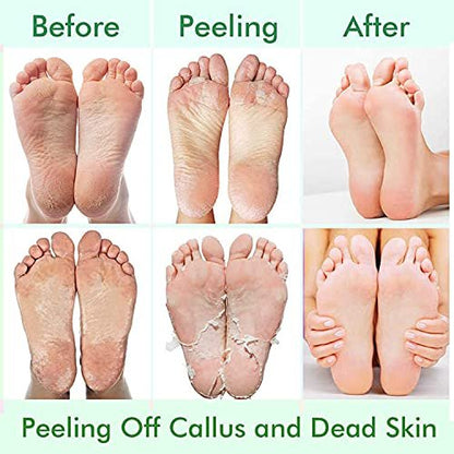 5 Pack Foot Peeling Mask - Exfoliator Peel Off Calluses, Dead Skin Remover for Dry Cracked Feet - Foot Peel Masks for Men and Women - Fathers Mothers Day Gifts