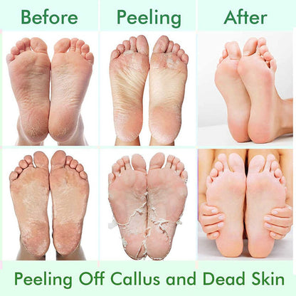 5 Pack Foot Peeling Mask - Exfoliator Peel Off Calluses, Dead Skin Remover for Dry Cracked Feet - Foot Peel Masks for Men and Women - Fathers Mothers Day Gifts