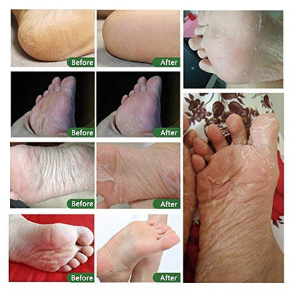 ALIVER Tea Tree Foot Peel Mask – 5 Pack Exfoliating Foot Care Mask for Soft, Baby-Smooth Feet – Removes Dead Skin, Calluses, and Roughness