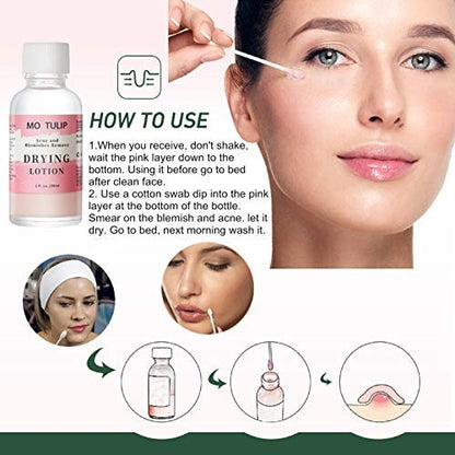 MO TULIP Acne Drying Lotion - Overnight Acne Spot Treatment with Salicylic Acid for Face and Body, 1 oz