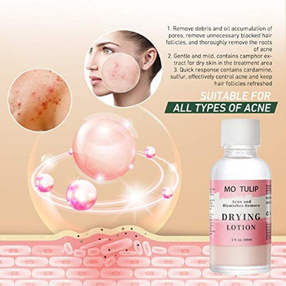 MO TULIP Acne Drying Lotion - Overnight Acne Spot Treatment with Salicylic Acid for Face and Body, 1 oz