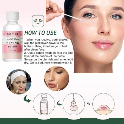 MO TULIP Acne Drying Lotion - Overnight Acne Spot Treatment with Salicylic Acid for Face and Body, 1 oz