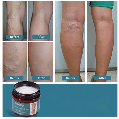 Jeosisy Varicose Vein Cream - Soothing Leg Cream for Varicose & Spider Veins, 1.76 Fl Oz