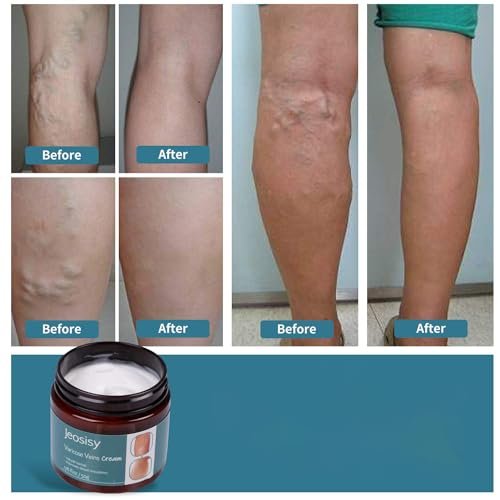Jeosisy Varicose Vein Cream - Soothing Leg Cream for Varicose & Spider Veins, 1.76 Fl Oz - görsel 6