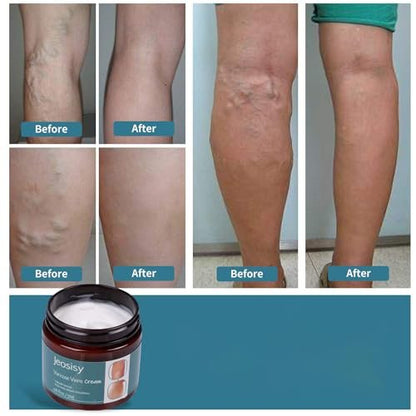 Jeosisy Varicose Vein Cream - Soothing Leg Cream for Varicose & Spider Veins, 1.76 Fl Oz